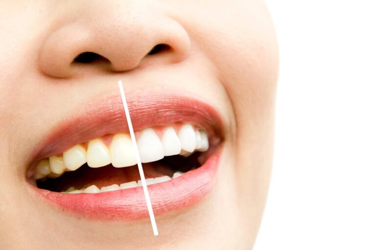 Professional Teeth Whitening: Everything You Need to Know Before